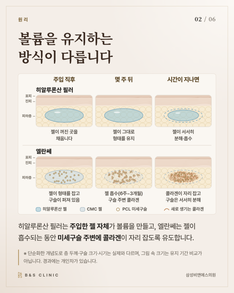 엘란쎄와 필러의 차이, 채운 볼륨을 무엇이 유지하는지부터 살펴봅니다 사진 2