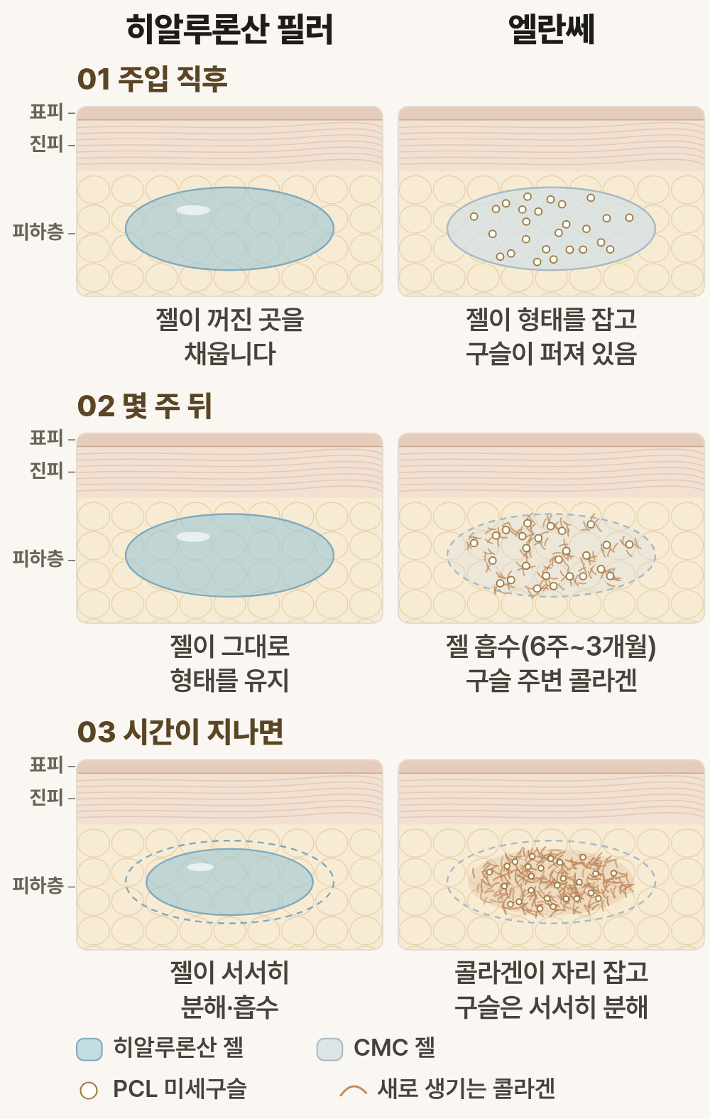 엘란쎄와 필러의 차이, 채운 볼륨을 무엇이 유지하는지부터 살펴봅니다 사진 8