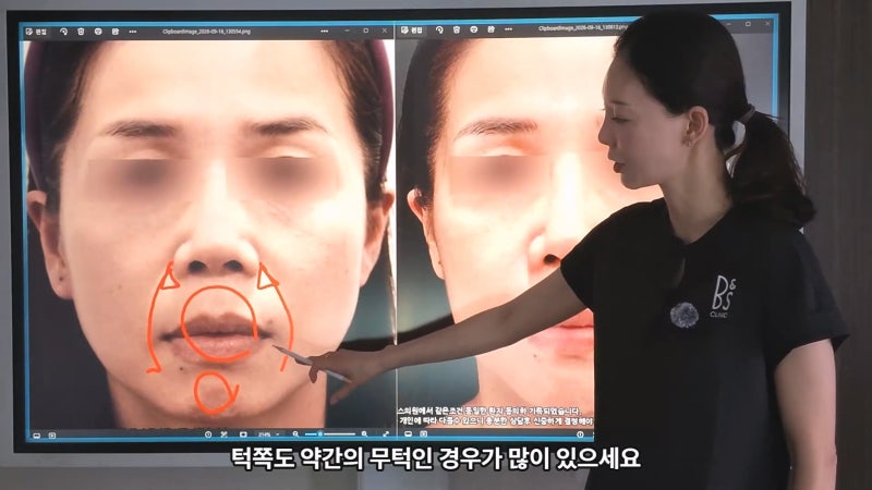 40대 팔자 선주름, 쥬브젠과 필러 시술 후 9개월 경과와 추가 시술 사진 2