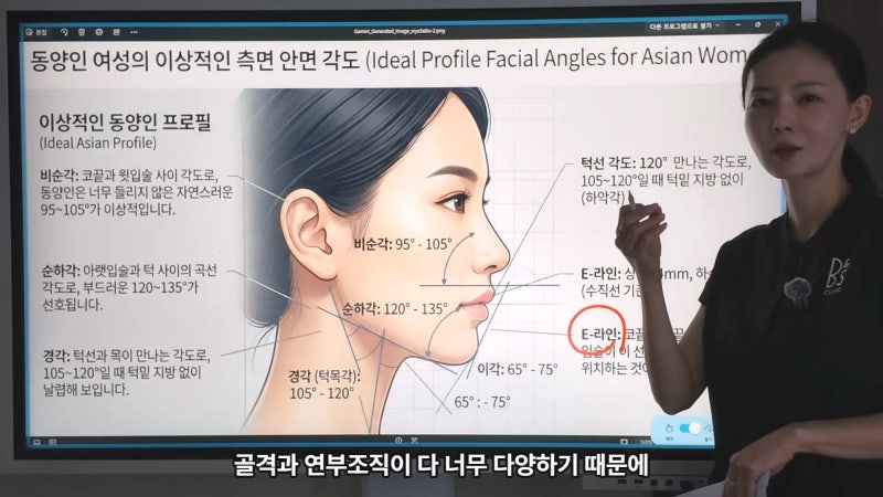 40대 팔자 선주름, 쥬브젠과 필러 시술 후 9개월 경과와 추가 시술 사진 8