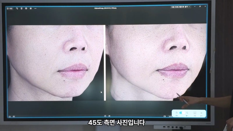 40대 팔자 선주름, 쥬브젠과 필러 시술 후 9개월 경과와 추가 시술 사진 5
