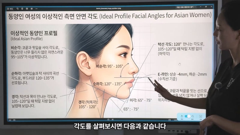 40대 팔자 선주름, 쥬브젠과 필러 시술 후 9개월 경과와 추가 시술 사진 7