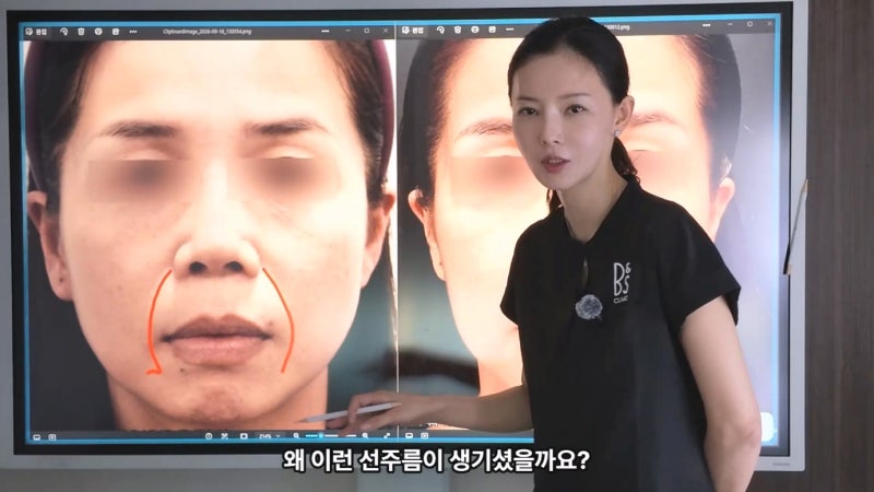 40대 팔자 선주름, 쥬브젠과 필러 시술 후 9개월 경과와 추가 시술