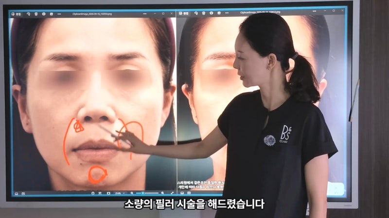 40대 팔자 선주름, 쥬브젠과 필러 시술 후 9개월 경과와 추가 시술 사진 3