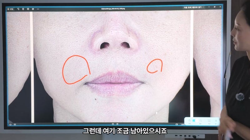 40대 팔자 선주름, 쥬브젠과 필러 시술 후 9개월 경과와 추가 시술 사진 4